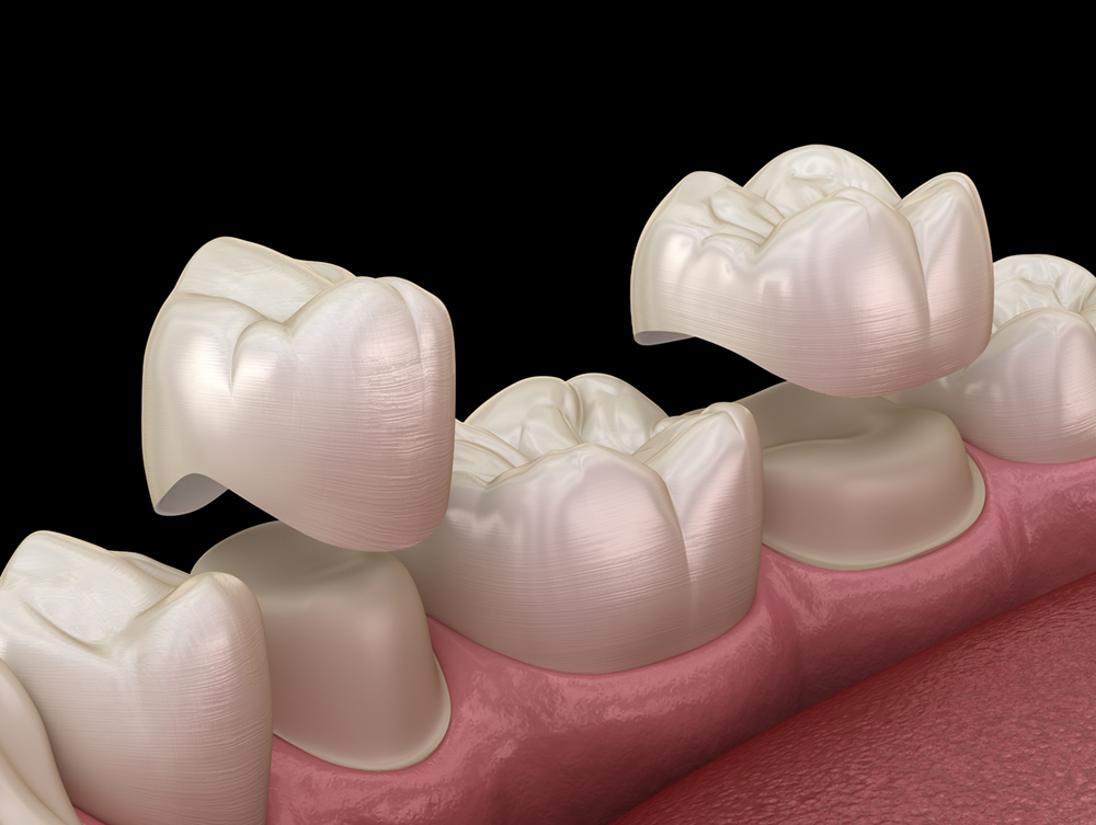 Dental model showing prepared teeth with crowns placed on top