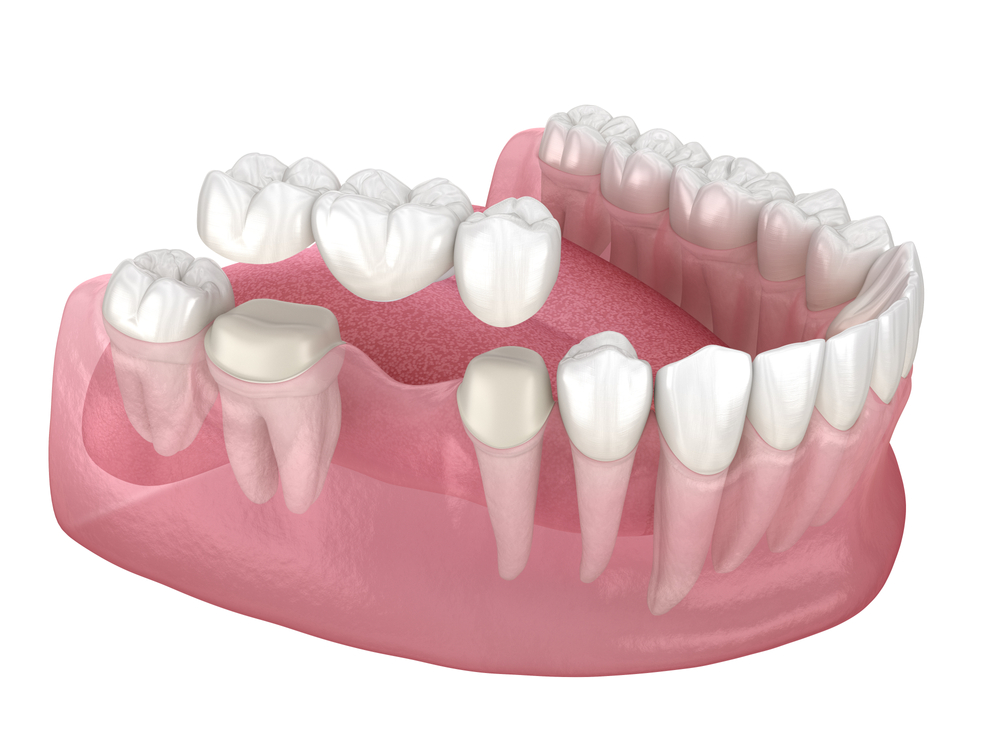 Dental model showing tooth bridges