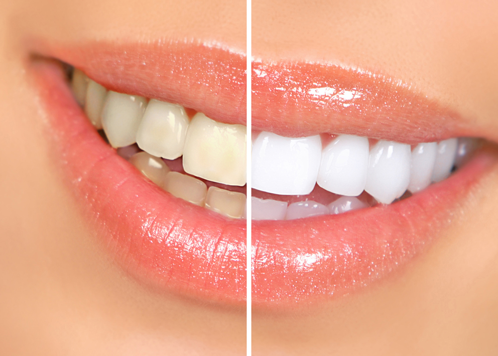 Before and after smile results from teeth whitening procedure