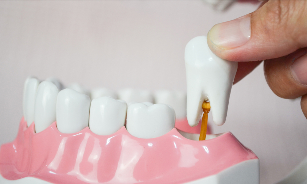 Tooth model representing wisdom teeth removal procedure
